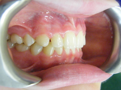 child overbite treatment