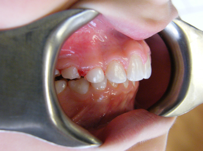 deep bite correction