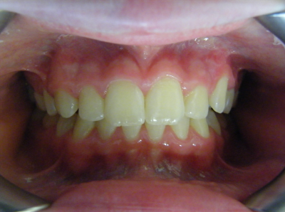 deep bite correction