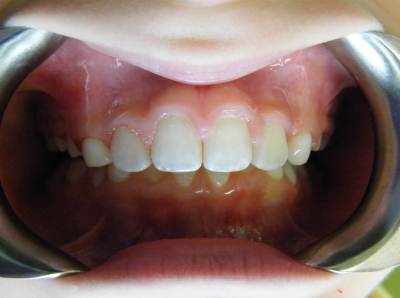deep bite correction