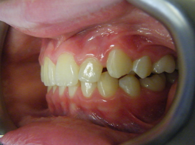 deep bite correction