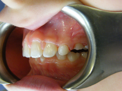 deep bite correction