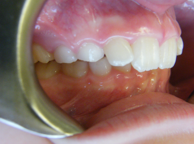 child overbite treatment