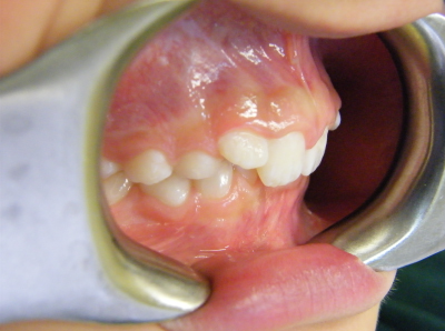 deep bite correction