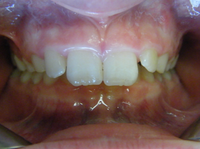 child overbite treatment