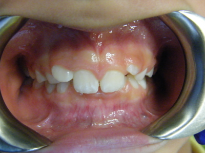 deep bite correction