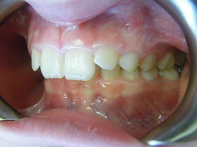 child overbite treatment