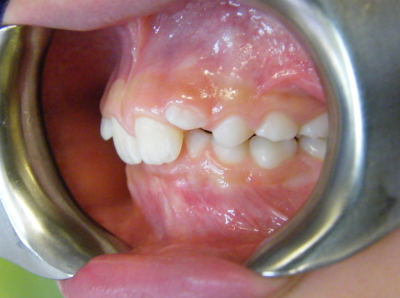 deep bite correction