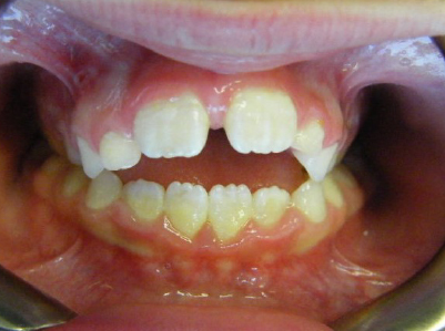 Early Treatment-Patient 2-Before-Middle Early-Treatment-Patient-2-Before-Middle.jpg