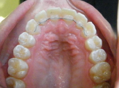Invisalign-Patient 1-After-1 Invisalign