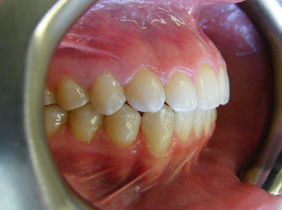 Invisalign-Patient 1-After-2 Invisalign