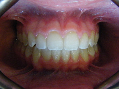Invisalign-Patient 1-After-3 Invisalign