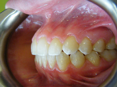 Invisalign-Patient 1-After-4 Invisalign