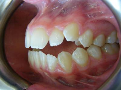 Invisalign-Patient 1-Before-4 Invisalign
