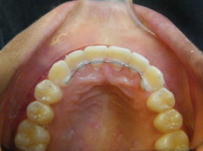 Invisalign-Patient 2-After-1 After Invisalign