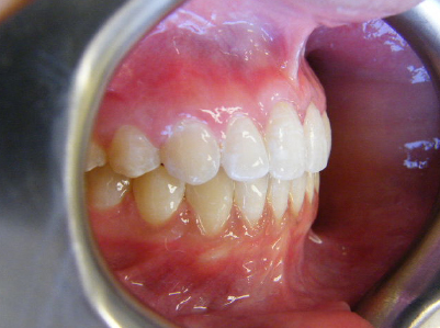 Invisalign-Patient 2-After-2 Invisalign After
