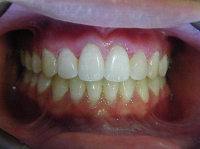 Invisalign-Patient 2-After-3 Invisalign Patient After