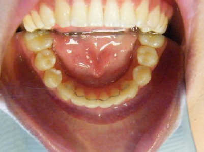 Invisalign-Patient 2-After-5 Invisalign After