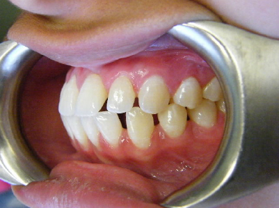Invisalign-Patient 2-Before-4 Invisalign