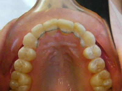 Invisalign-Patient 3-After-1 invisalign for teens Patient after