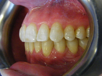 Invisalign-Patient 3-After-4 invisalign for teens Patient