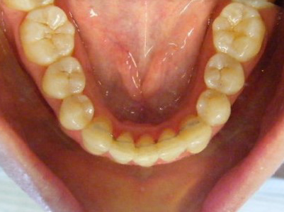 Invisalign-Patient 3-After-5 invisalign for teens Patient