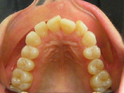 Invisalign-Patient 3-Before-1 Invisalign