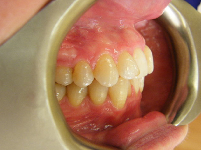 Invisalign-Patient 3-Before-2 invisalign for teens Patient before treatment