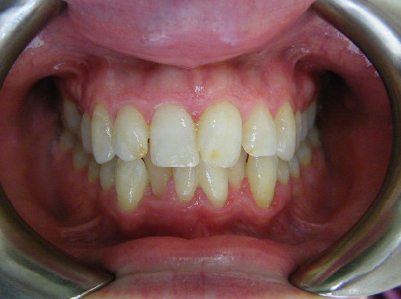 Invisalign-Patient 3-Before-3 invisalign for teens Patient before treatment
