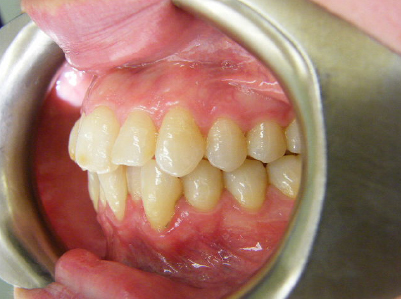 Invisalign-Patient 3-Before-4 invisalign for teens Patient before treatment
