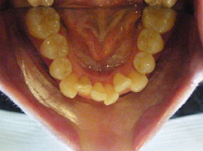 Invisalign-Patient 3-Before-5 invisalign for teens Patient before treatment