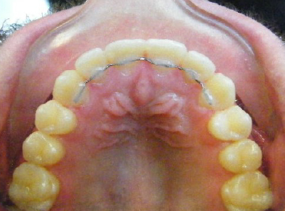 Invisalign-Patient 4-After-1 invisalign for teens Patient