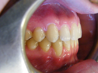 Invisalign-Patient 4-After-2 Invisalign-Patient-4-After-2.jpg