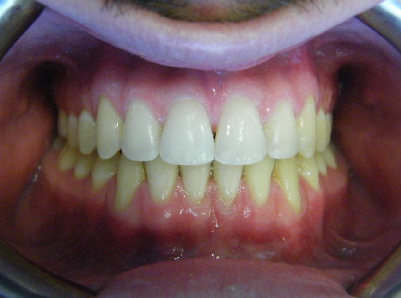 Invisalign-Patient 4-After-3 After invisalign for teens