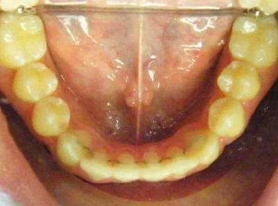 Invisalign-Patient 4-After-5 invisalign for teens Patient