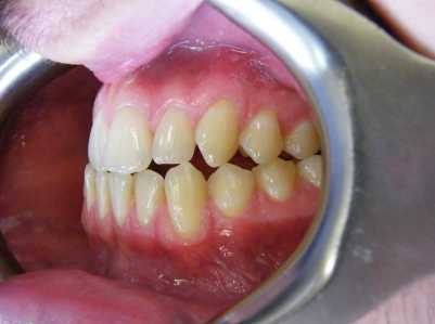 Invisalign-Patient 4-Before-4 invisalign for teens Patient before