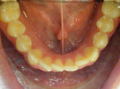 Invisalign-Patient 4-Before-5 Before invisalign for teens Patient