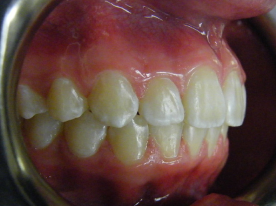 jaw-expansion-after-left.jpg