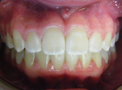 jaw-expansion-after-middle.jpg