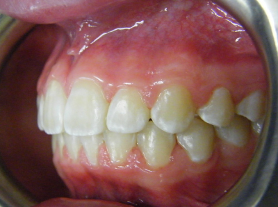 jaw-expansion-after-right.jpg