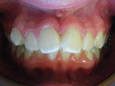 jaw-expansion-before-middle.jpg