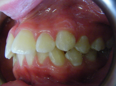 jaw-expansion-before-right.jpg