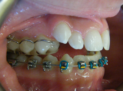 jaw-expansion-treatment-left.jpg