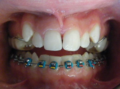 jaw-expansion-treatment-middle.jpg