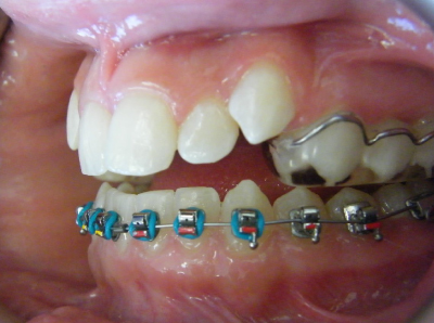 jaw-expansion-treatment-right.jpg